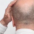 Understanding Alopecia