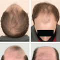 Understanding Male Pattern Baldness: Causes and Genetics