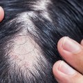 Iron-Deficiency Anemia and Hair Loss: What You Need to Know