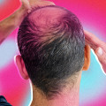 Hair Care Routine for Managing Male Pattern Baldness