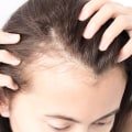 Natural Remedies for Female Hair Loss: Understanding Diagnosis and Treatment