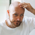 Understanding the Link Between Lifestyle Factors and Male Pattern Baldness