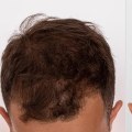 Understanding Minoxidil for Hair Loss: A Comprehensive Guide