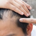 Understanding Genetics and Male Pattern Baldness: What You Need to Know