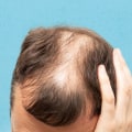 Female Hair Loss: Causes and Risk Factors