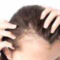 Hormonal Imbalances and Hair Loss: Understanding the Link and Finding Solutions