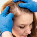 Understanding Medical Treatments for Female Hair Loss