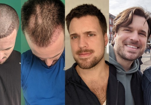 The Ins and Outs of Hair Transplants