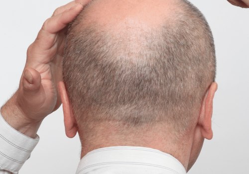 Understanding Alopecia