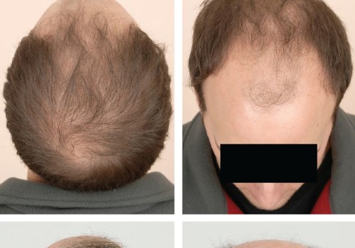 Understanding Male Pattern Baldness: Causes and Genetics