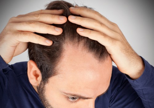 Lifestyle Changes for Preventing Male Pattern Baldness: A Comprehensive Guide