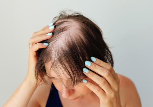 Lifestyle Factors and Female Hair Loss: Understanding the Connection