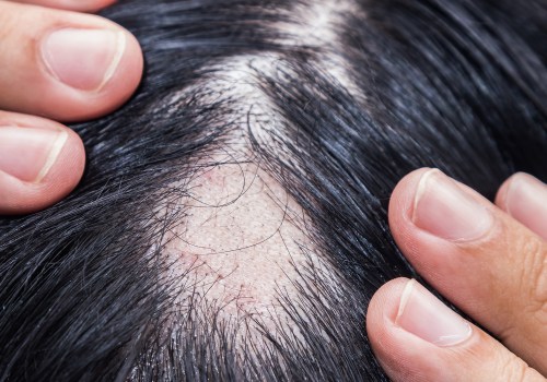 Iron-Deficiency Anemia and Hair Loss: What You Need to Know