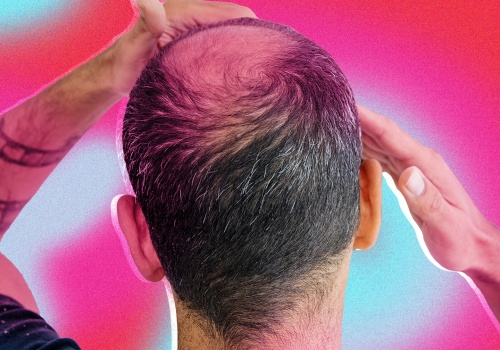 Hair Care Routine for Managing Male Pattern Baldness