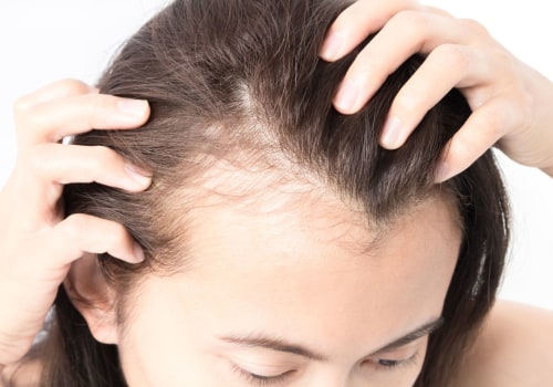 Natural Remedies for Female Hair Loss: Understanding Diagnosis and Treatment