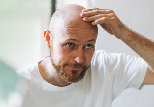 Understanding the Link Between Lifestyle Factors and Male Pattern Baldness