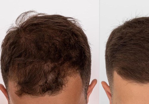 Understanding Minoxidil for Hair Loss: A Comprehensive Guide