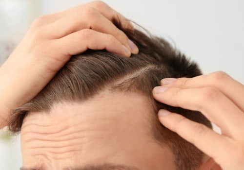 Understanding Finasteride: A Comprehensive Guide to Hair Loss Treatment