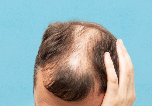 Understanding Hereditary Hair Loss