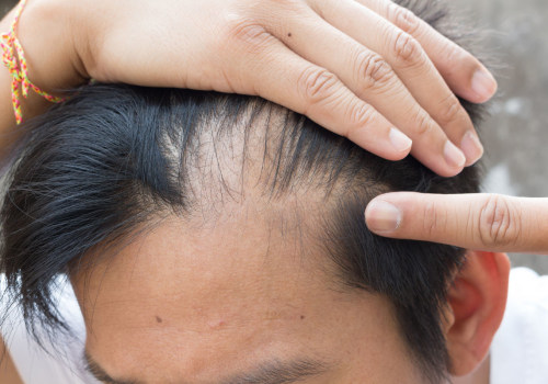 Understanding Genetics and Male Pattern Baldness: What You Need to Know