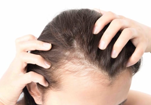 Hormonal Imbalances and Hair Loss: Understanding the Link and Finding Solutions