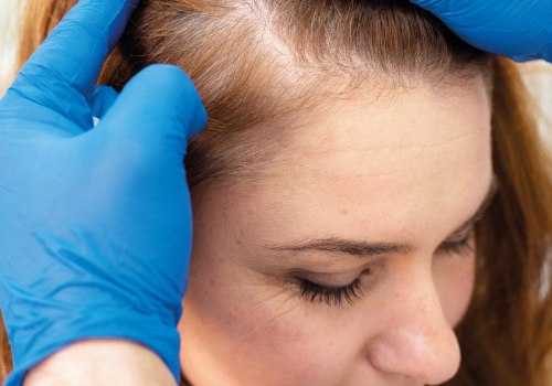 Understanding Medical Treatments for Female Hair Loss